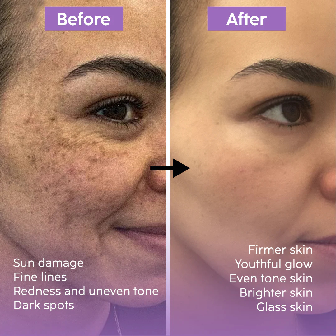 Teashell Niacinamide Brightening Serum |BUY ONE GET ONE FREE/ Fades Dark Spots, Evens Skin Tone & Boosts Glow