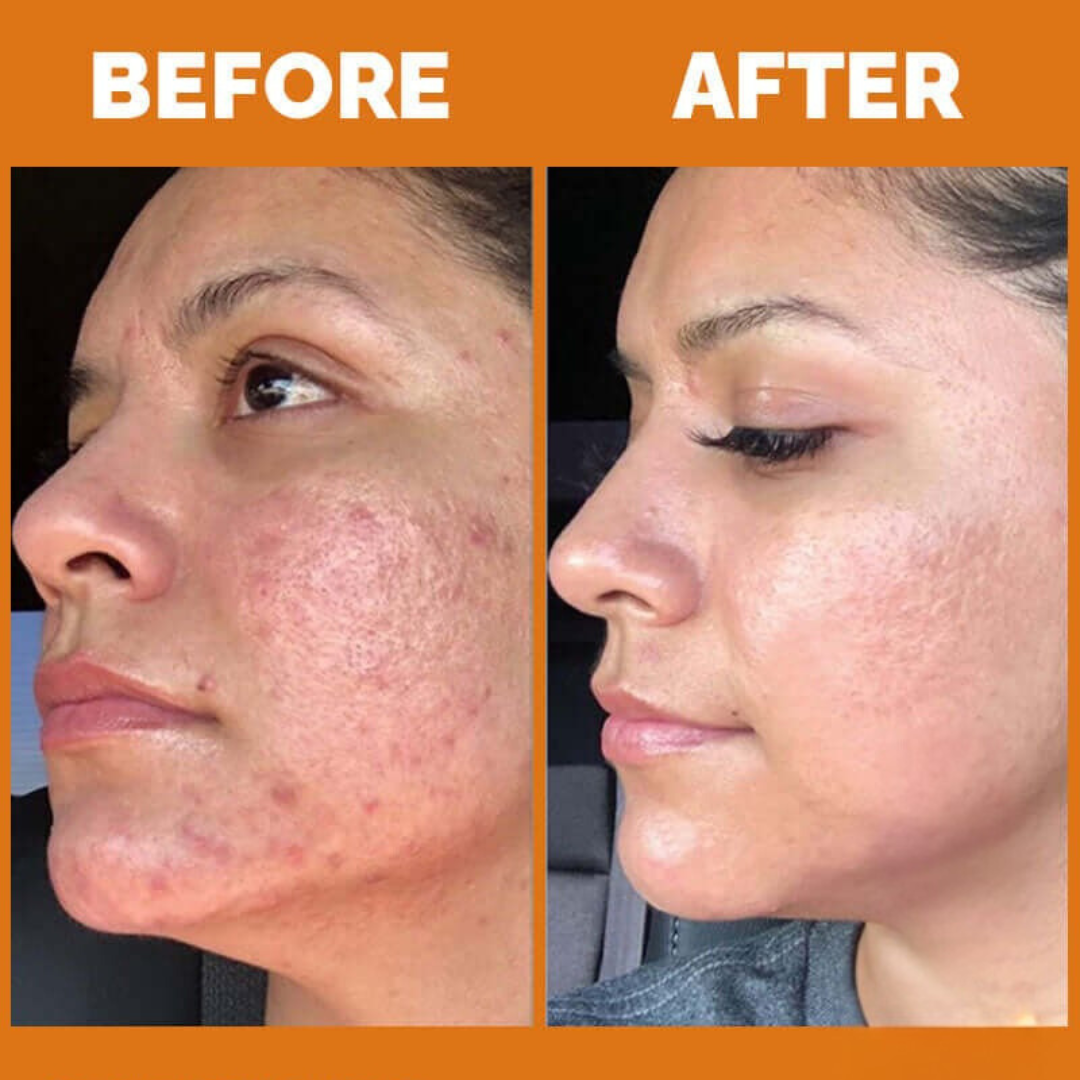 Teashell Niacinamide Brightening Serum |BUY ONE GET ONE FREE/ Fades Dark Spots, Evens Skin Tone & Boosts Glow