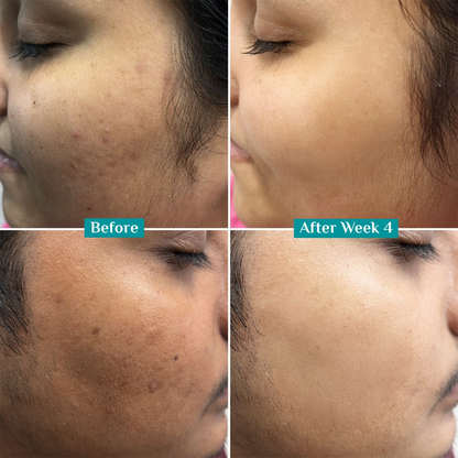 Teashell Niacinamide Brightening Serum |BUY ONE GET ONE FREE/ Fades Dark Spots, Evens Skin Tone & Boosts Glow